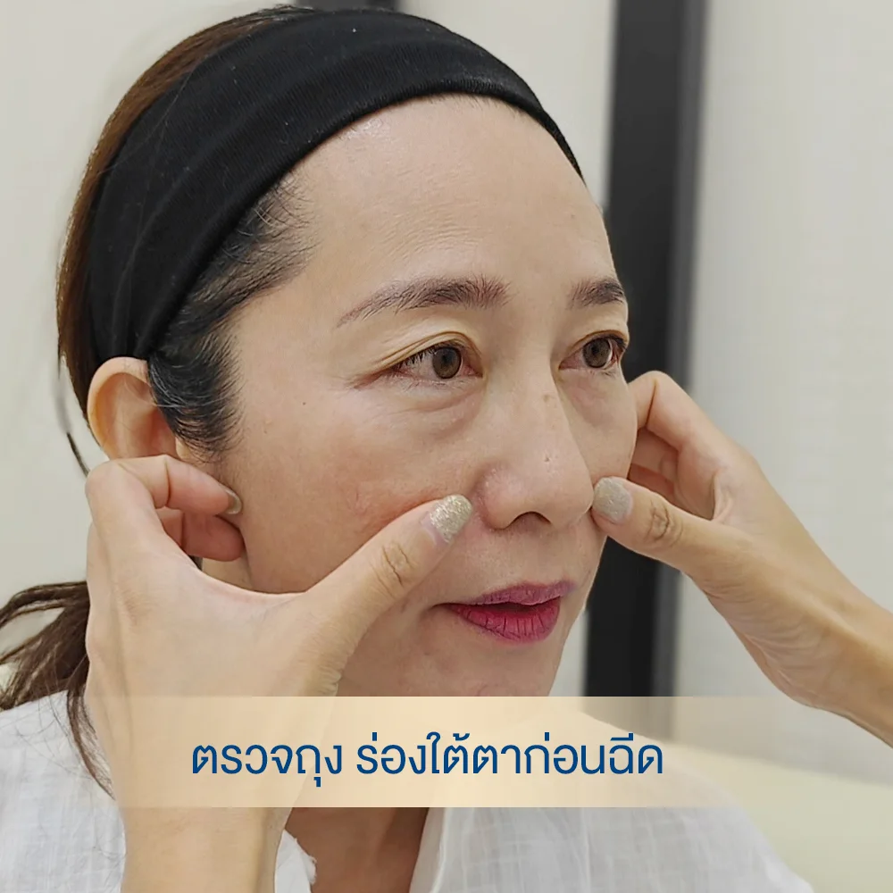 เติมฟิลเลอร์ใต้ตา เปลี่ยนชีวิต เติมความสดใสให้ดวงตา ดูเด็กลงในทันที