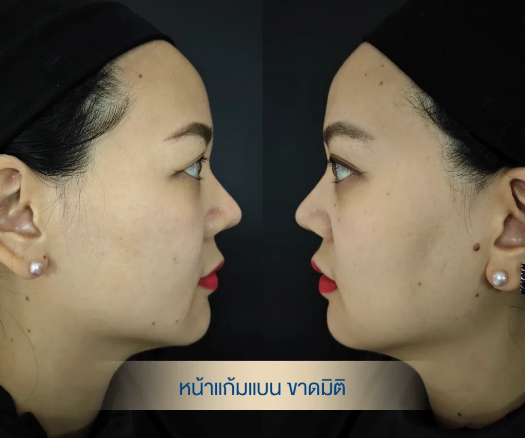 แก้มแบนมาก ฉีดฟิลเลอร์กี่ cc dlovevery-clinic