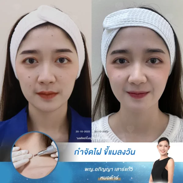 จากวันที่หมอดูทักเรื่องไฝ กลายเป็นวันที่เริ่มดูแลผิวหน้าจริงจัง