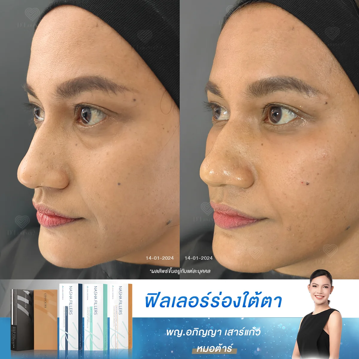 บอกลาใต้ตาคล้ำ ด้วยฟิลเลอร์ เคล็ดลับใบหน้าดูสดชื่นทันใจกับหมอต้าร์