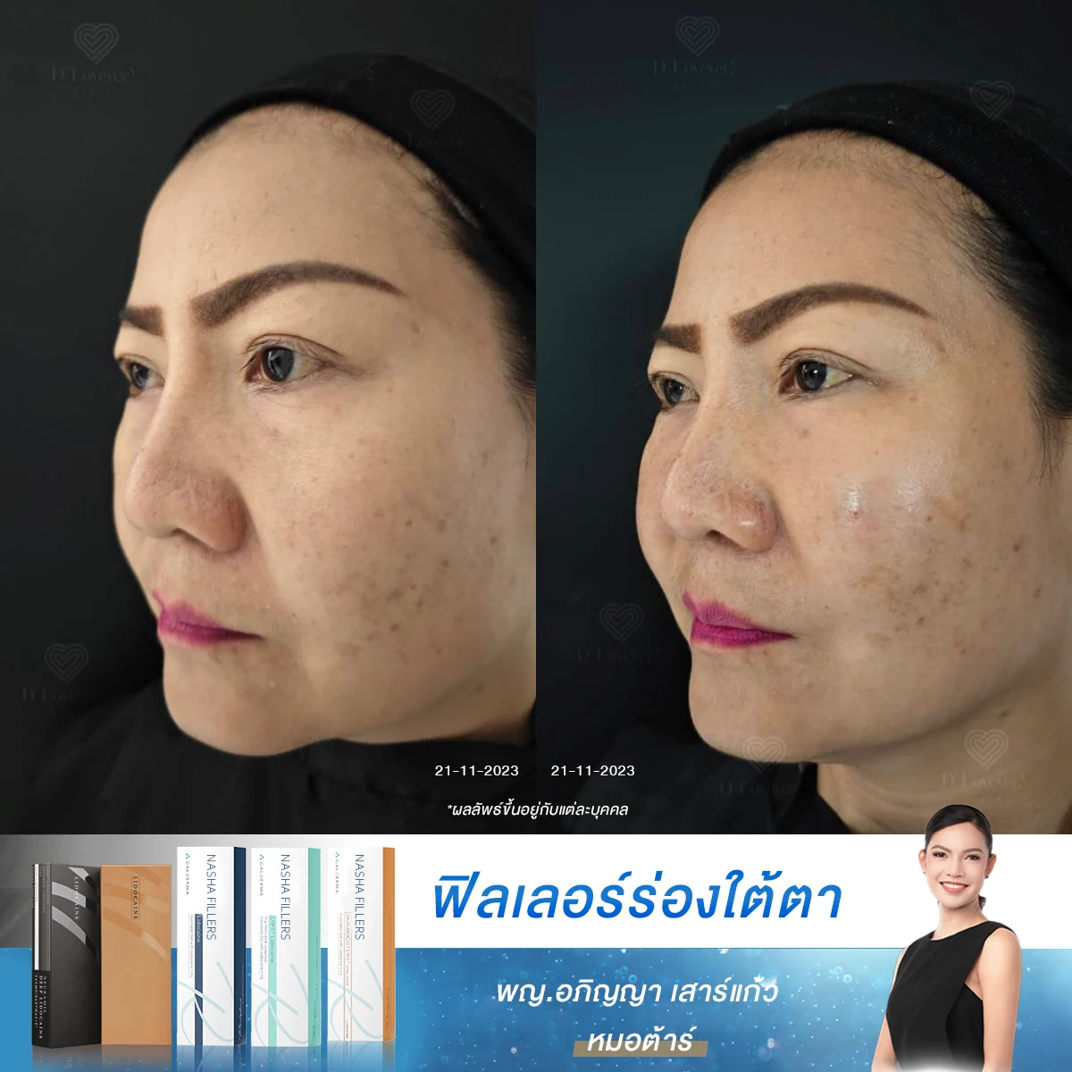 50 แล้วยังรอด! รีวิวฟิลเลอร์ใต้ตา เปลี่ยนหน้าหมองเป็นสดใสใน 30 นาที