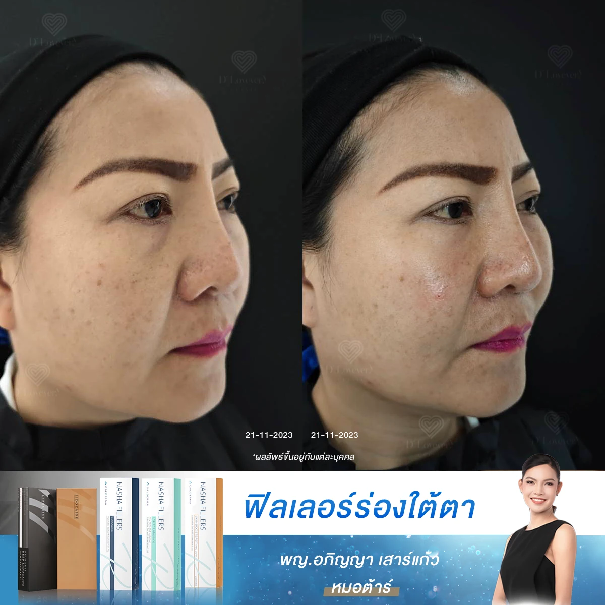 50 แล้วยังรอด! รีวิวฟิลเลอร์ใต้ตา เปลี่ยนหน้าหมองเป็นสดใสใน 30 นาที