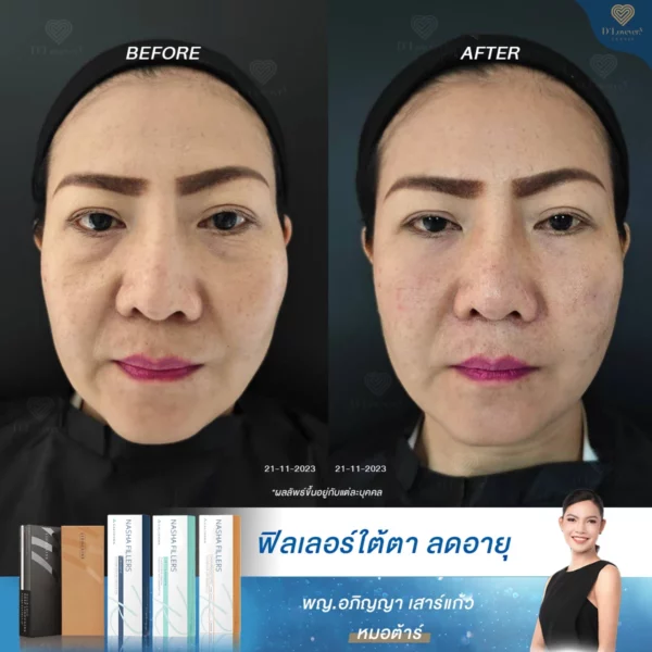 ประสบการณ์ตรง: ฟิลเลอร์ใต้ตาครั้งแรกของคนวัย 50 จะธรรมชาติไหม?