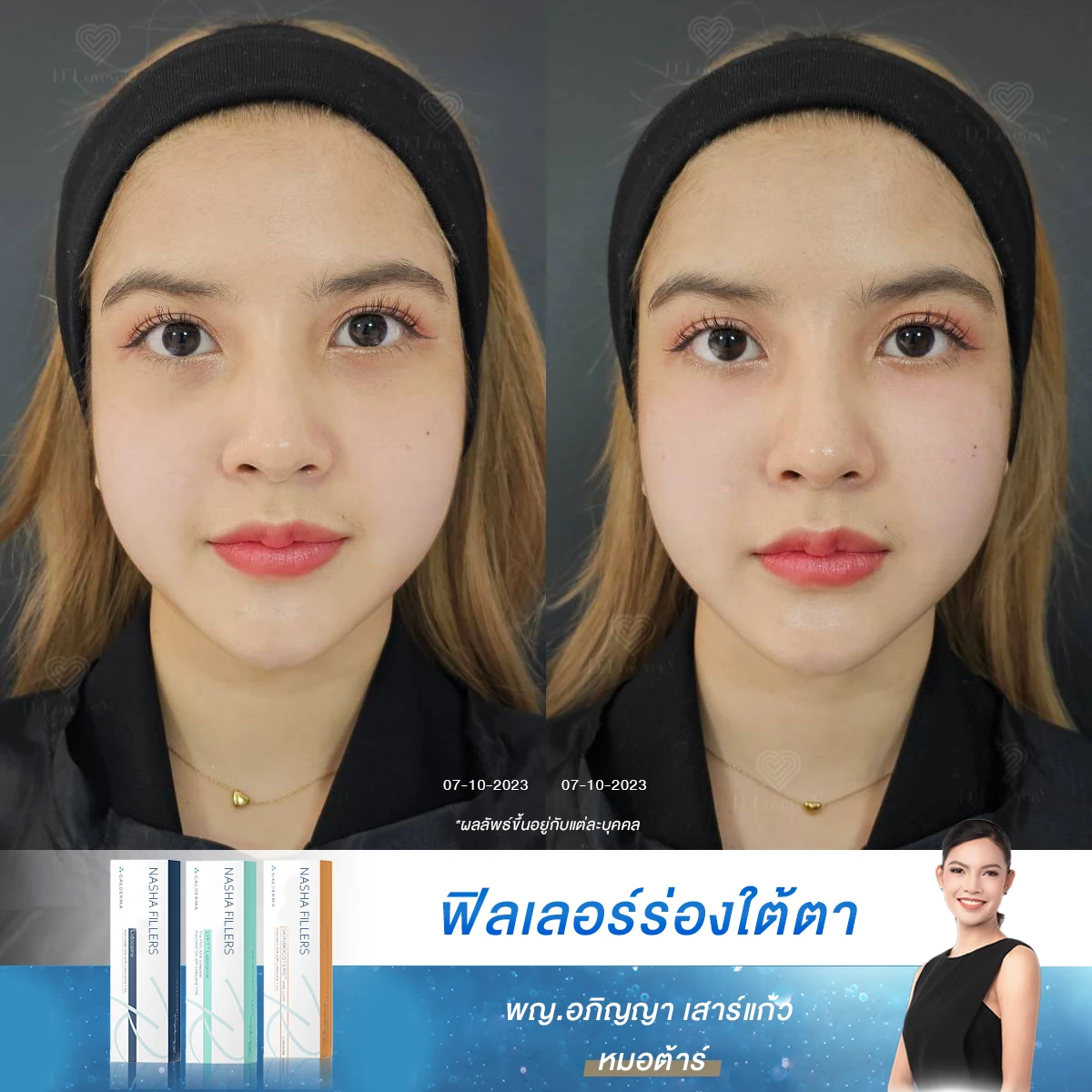 นอนเยอะก็ยังแพนด้า? เผยเคล็ดลับแก้ปัญหาใต้ตาคล้ำสายวัยทีนที่เห็นผลจริง