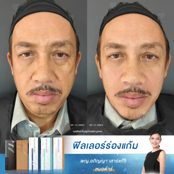 ร่องแก้มลึกส่งผลต่อบุคลิกและความมั่นใจ ฟิลเลอร์คือคำตอบ