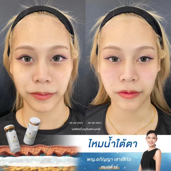 รีวิวไหมน้ำใต้ตา ช่วยวัยรุ่นฟื้นคืนใต้ตาใส ปลอดภัยไม่ง้อฟิลเลอร์