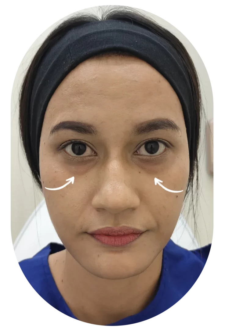 before ก่อนฉีดฟิลเลอร์ใต้ตา ถุงใต้ตา ร่องใต้ตาลึก แก้ไขยังไง รีวิว dlovevery clinic