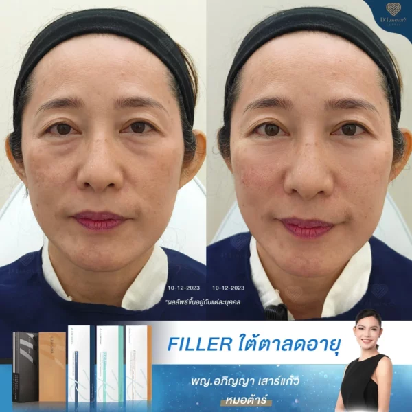 เหตุผลที่วัย 45-60 ปี มีริ้วรอยและรอยย่นใต้ตา