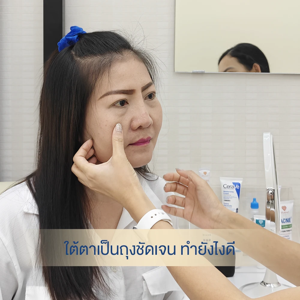 case 65 ก่อน-หลังฉีดฟิลเลอร์ใต้ตา ถุงใต้ตาชัดเจนมาก dlovevery clinic