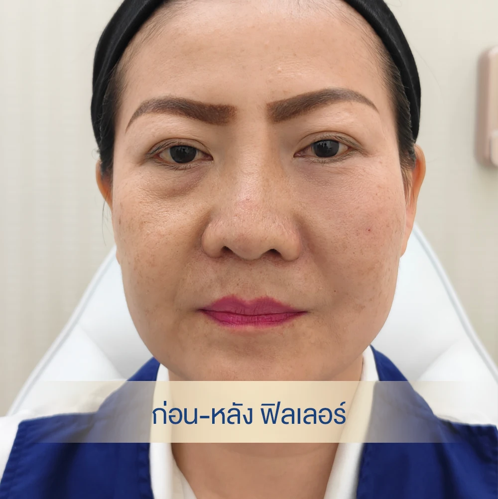 case 65 ก่อน-หลังฉีดฟิลเลอร์ใต้ตา เทียบข้างต่อข้าง dlovevery clinic