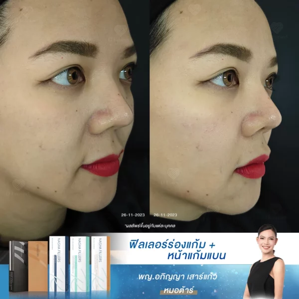 สียดายเวลาชีวิต! ถ้ารู้ว่าฉีดฟิลเลอร์ร่องแก้มดีขนาดนี้ คงมาทำตั้งแต่แรก
