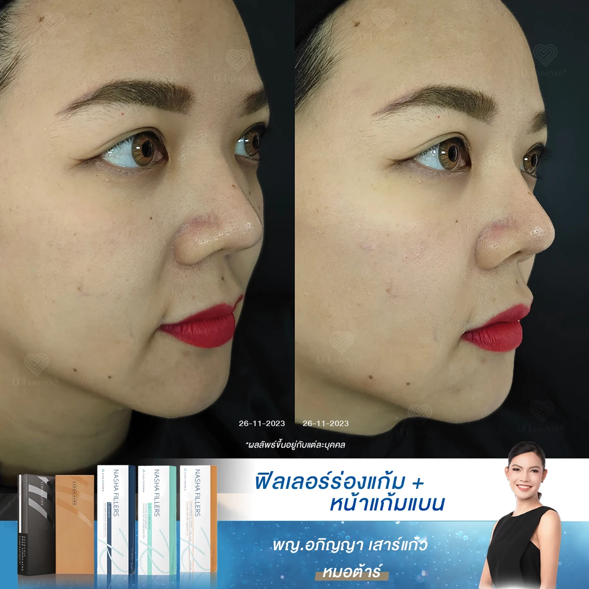 สียดายเวลาชีวิต! ถ้ารู้ว่าฉีดฟิลเลอร์ร่องแก้มดีขนาดนี้ คงมาทำตั้งแต่แรก
