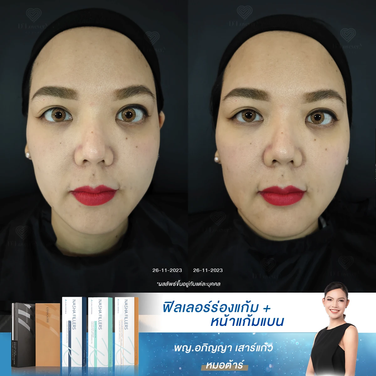 ถ้ารู้ว่าฟิลเลอร์ช่วยได้ขนาดนี้ จะไม่เสียเวลาทุกข์ใจกับร่องแก้มลึกเลย