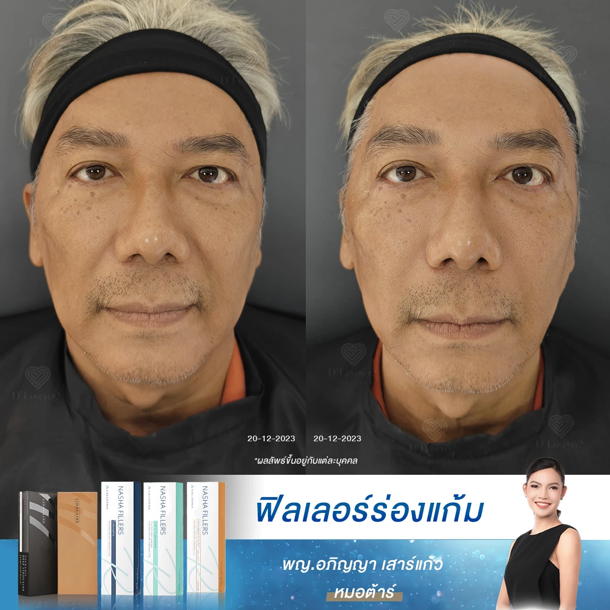 รีวิวหน้าเป๊ะ ไม่มีร่องลึกไม่มีจุด กระเนื้อ ชีวิตง่ายขึ้นเยอะ