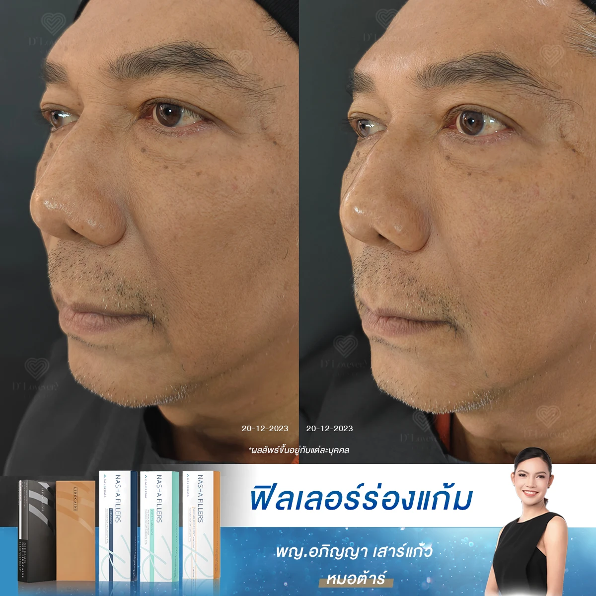 ดูแลจบที่เดียว! ฟิลเลอร์ร่องแก้ม เติมเต็ม กระเนื้อจุดเล็ก ๆ ไม่รบกวนใจ