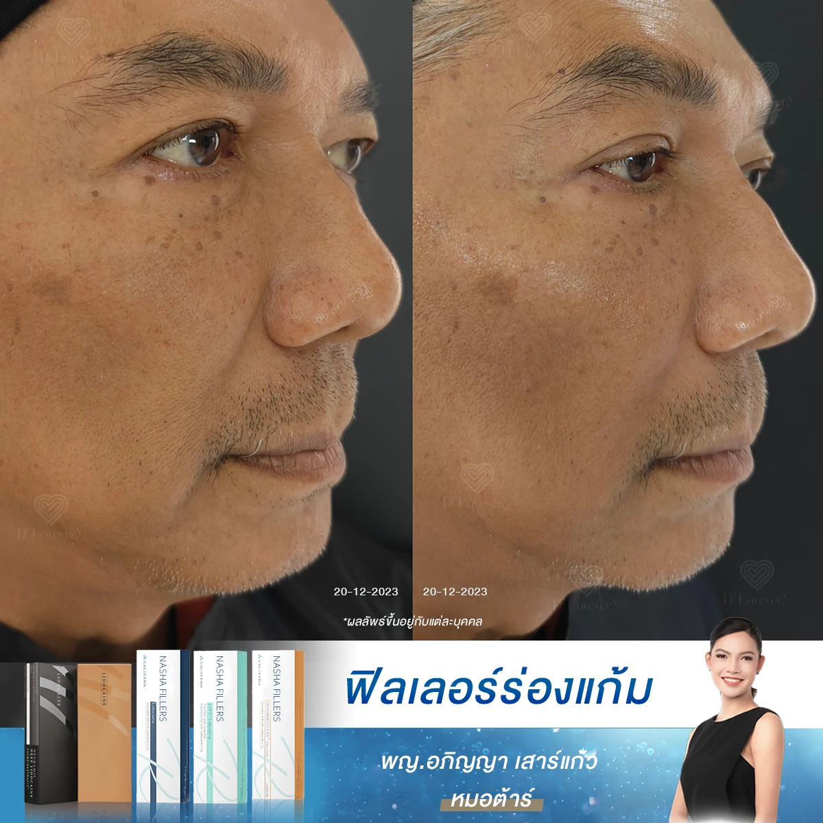 หมดปัญหาหน้าโทรม ร่องลึก กระเนื้อกวนใจ ด้วยโปรแกรมครบวงจร