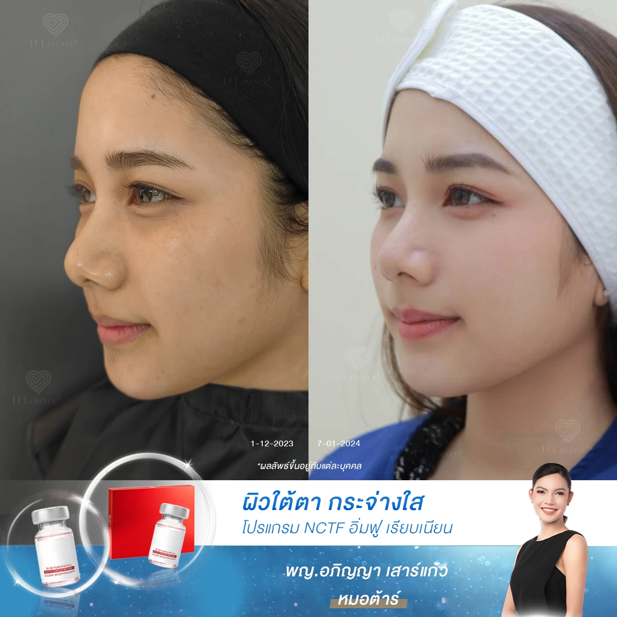 ผลลัพธ์ใต้ตาสดใส nctf 135 ha