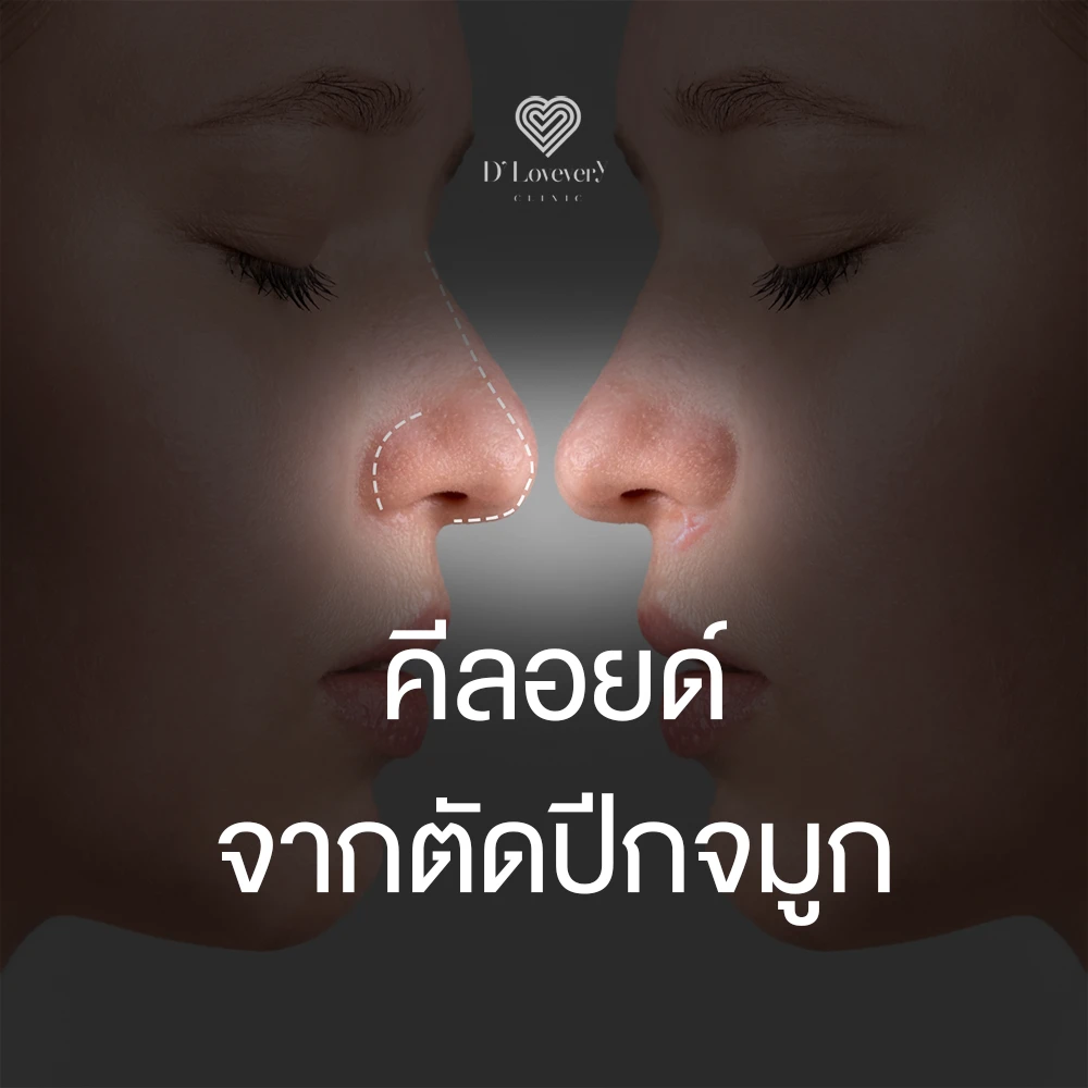 ตีลอยด์ จากการตัดปีกจมูก ฉีดกี่ครั้ง รักษาหายไหม