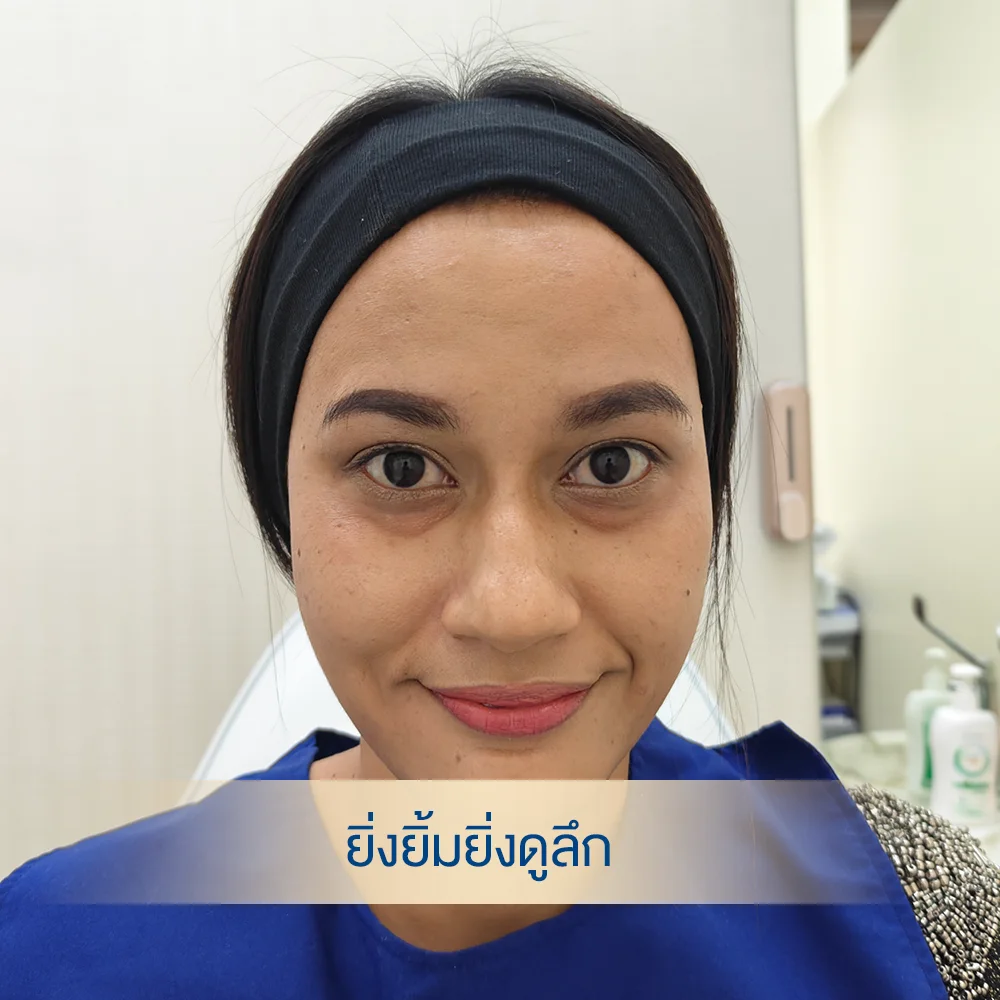 ยิ่งยิ้ม ใต้ตายิ่งดูลึกกว่าปกติ กังวลมาก กลายเป็นคนยิ้มยาก