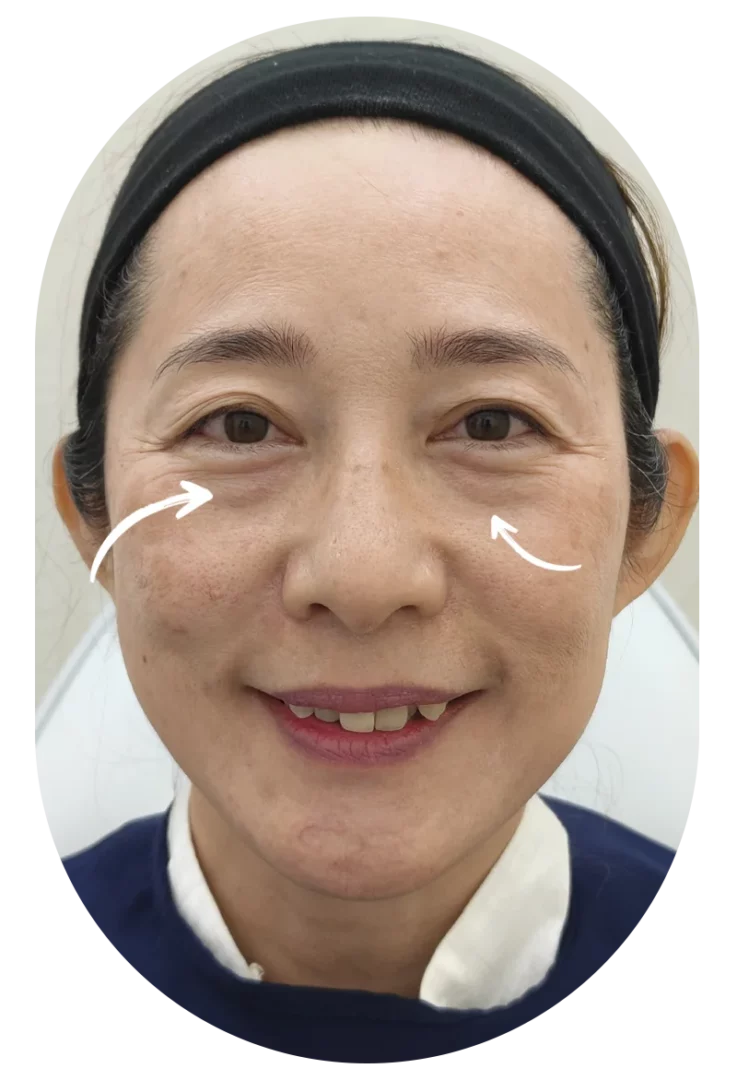 ริ้วรอยใต้ตา ร่องใต้ตา รักษายังไง รีวิวฟิลเลอร์ใต้ตา case 60 dlovevery clinic