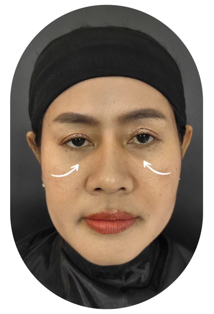 รีวิวฟิลเลอร์ใต้ตา อายุ 50 ใต้ตาคล้ำลึก dlovevery clinic
