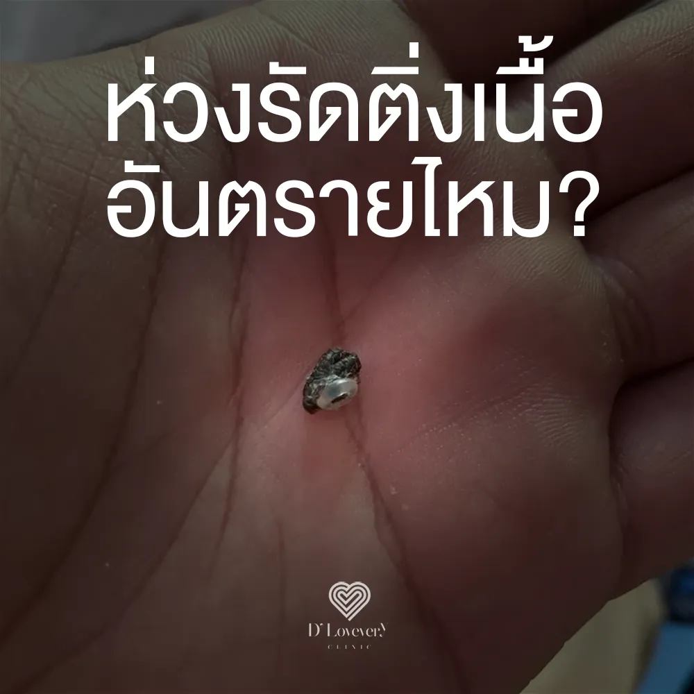 ห่วงรัดติ่งเนื้อ กระเนื้อ อันตรายไหม ทำไมคนบอกใช้ดี หรือทำเลเซอร์ดี