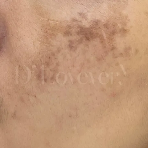 เป็นฝ้าที่โหนกแก้ม เข้มแค่โหนกแก้ม รักษายังไง dlovevery clinic