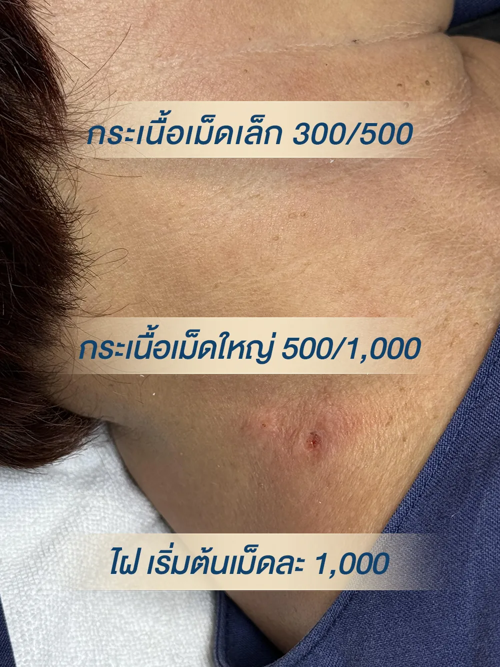 จี้กระเนื้อ ราคาเท่าไหร่ ต่อจุด ราคาเหมาที่หน้า 5000 ที่คอ 5000 เหมาะหน้าและคอ 8000