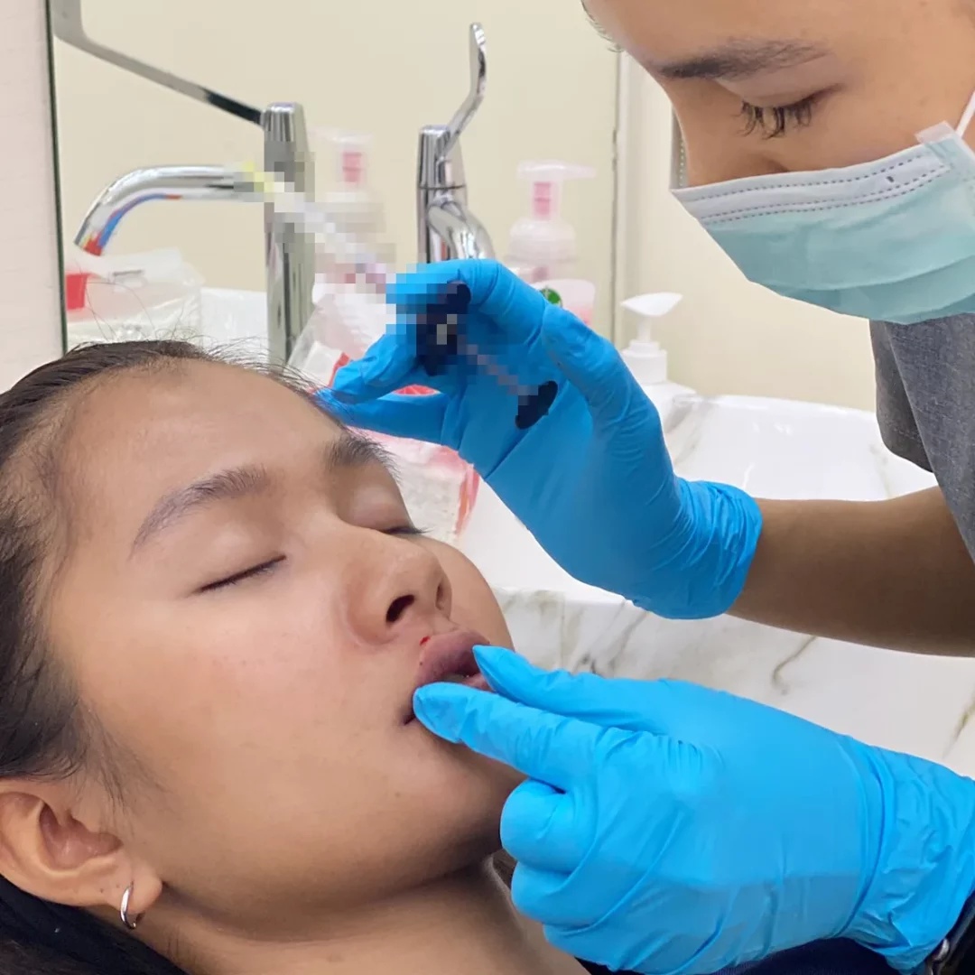 ฉีดปากอวบอิ่ม ต้องใช้ฟิลเลอร์ตัวไหน ใช้กี่ cc