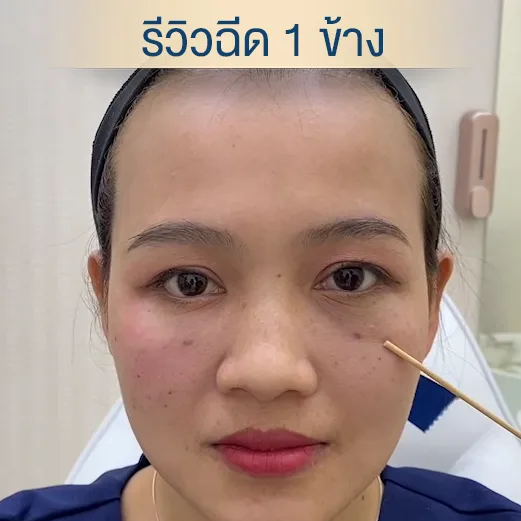 ฉีดฟิลเลอร์ใต้ตา 1 cc restylane vital skinboosters-1