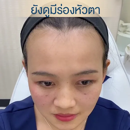 ฉีดฟิลเลอร์ใต้ตา 1 cc restylane vital skinboosters-2