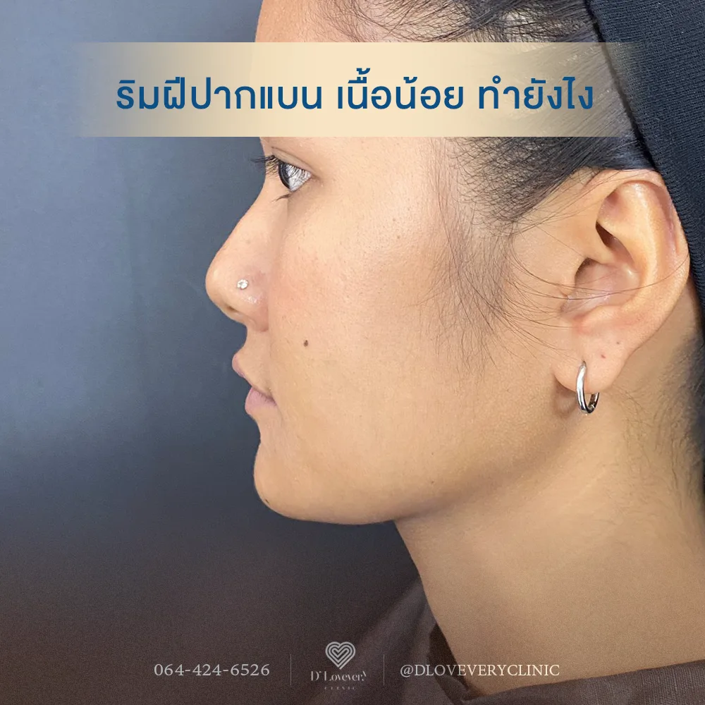 ริมฝีปากแบน เนื้อน้อย แก้ไขยังไงได้บ้าง ฉีดฟิลเลอร์ช่วยได้ไหม
