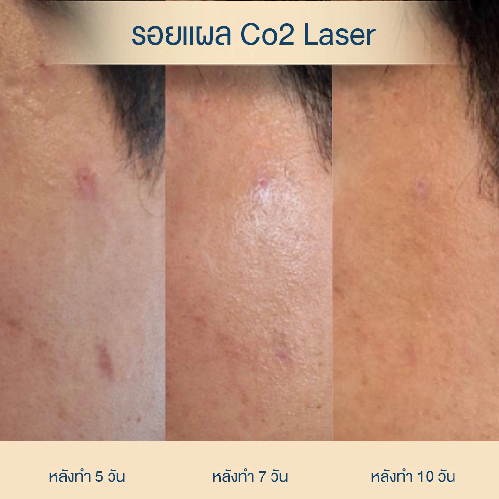 หลังจี้ไฝ จะเป็นรอยแผลเป็นไหม co2 laser จะเป็นรอยดำไหม