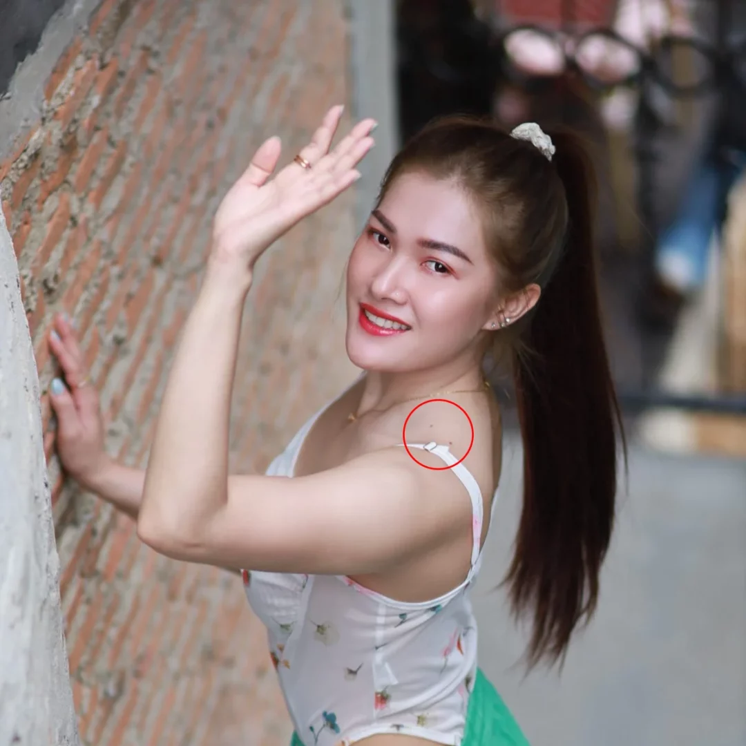 ไฝ ขี้แมลงวัน กวนใจ อยากกำจัด อยากเอาไฝออก