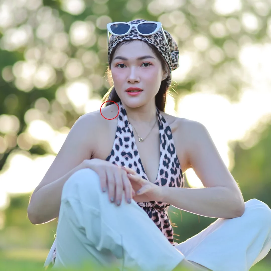 ไฝ ขี้แมลงวัน กวนใจ อยากกำจัด อยากเอาไฝออก