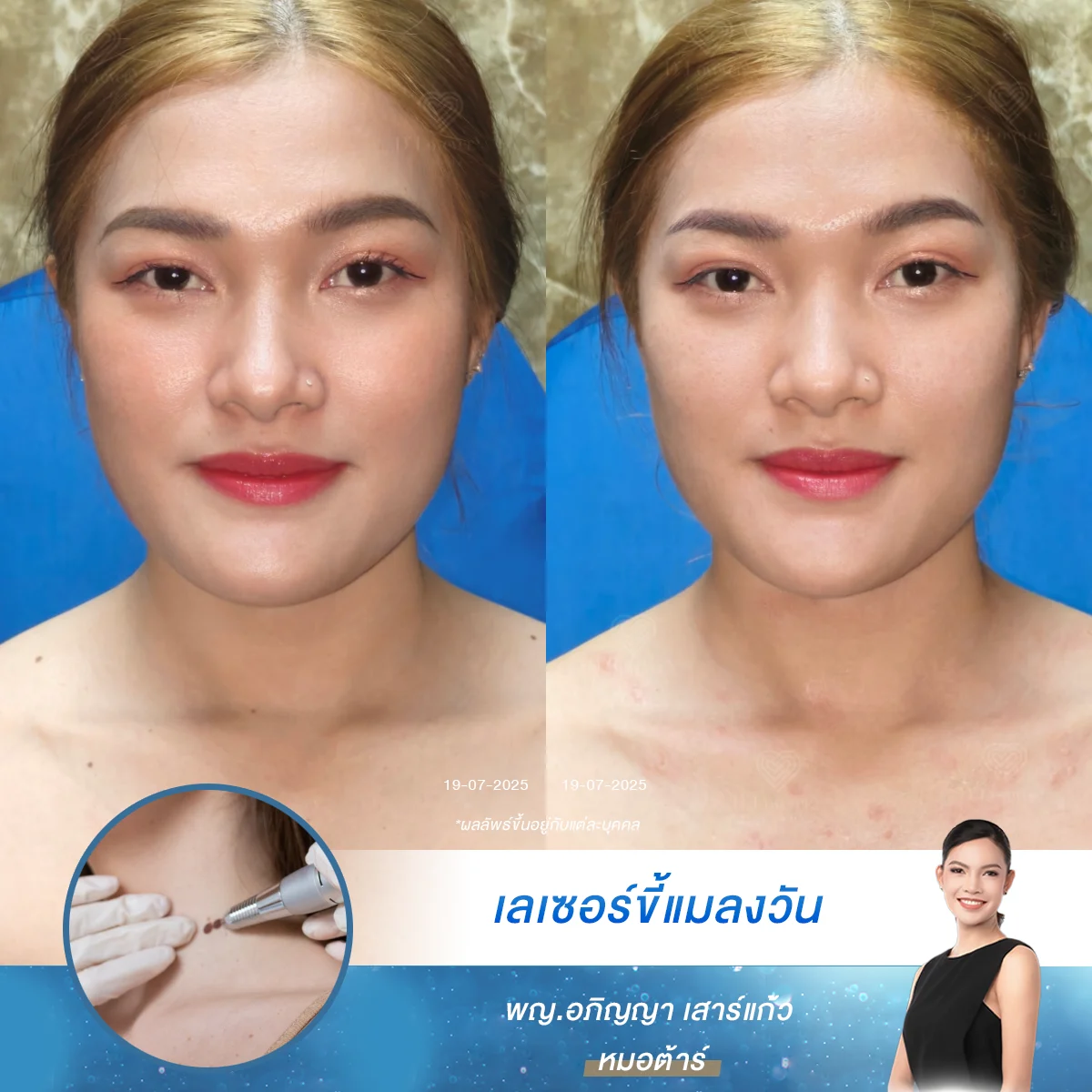 ใครมีขี้แมลงวันหรือกระเนื้อสะสม มาทำเลเซอร์ที่ D’Lovevery Clinic เห็นผลตั้งแต่ครั้งแรก ดูแลโดยแพทย์เฉพาะทาง