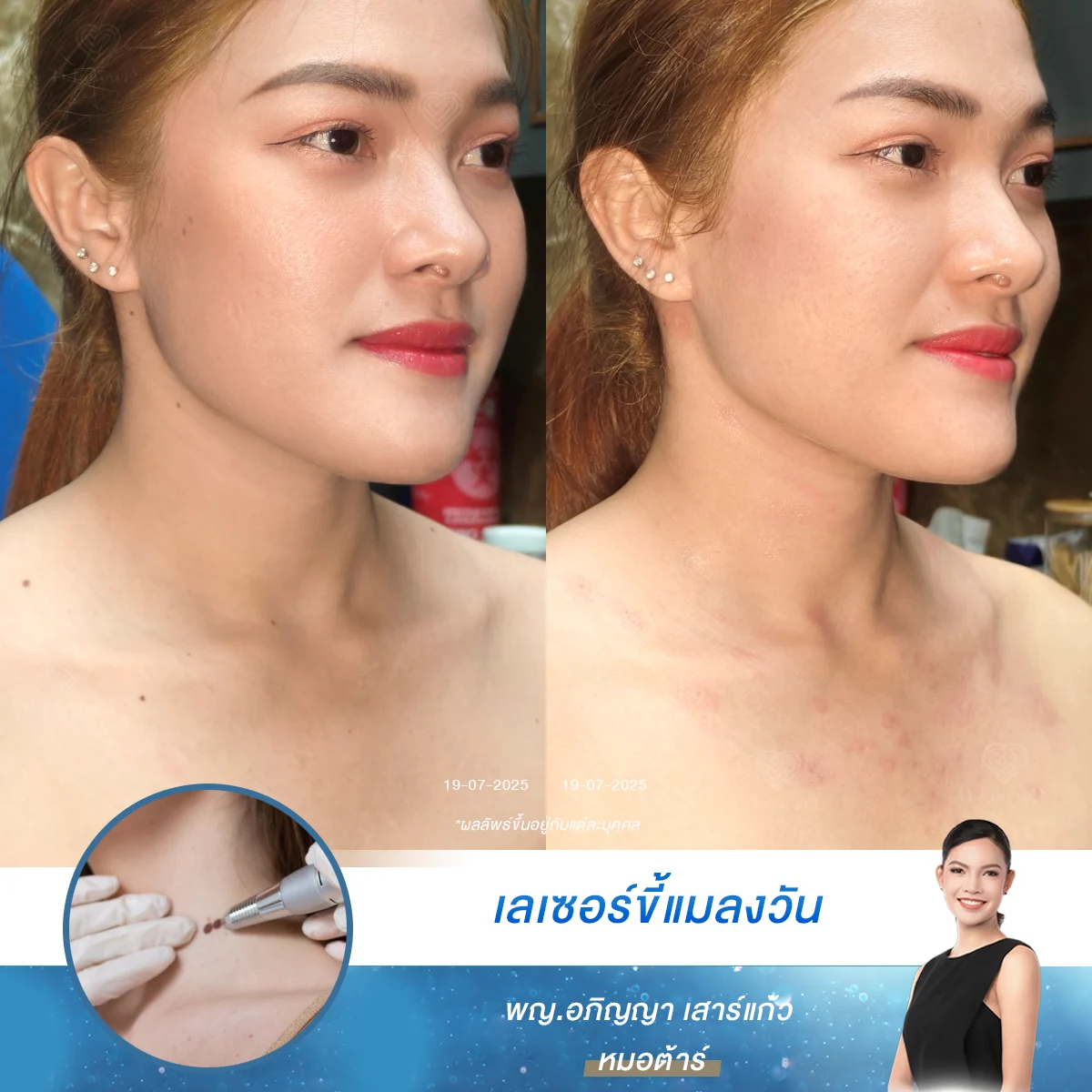 กำจัดขี้แมลงวัน และกระเนื้อทั่วใบหน้าและลำคออย่างอ่อนโยน คืนความเนียนใสให้ผิวด้วยเลเซอร์มาตรฐานใหม่ที่ D’Lovevery Clinic