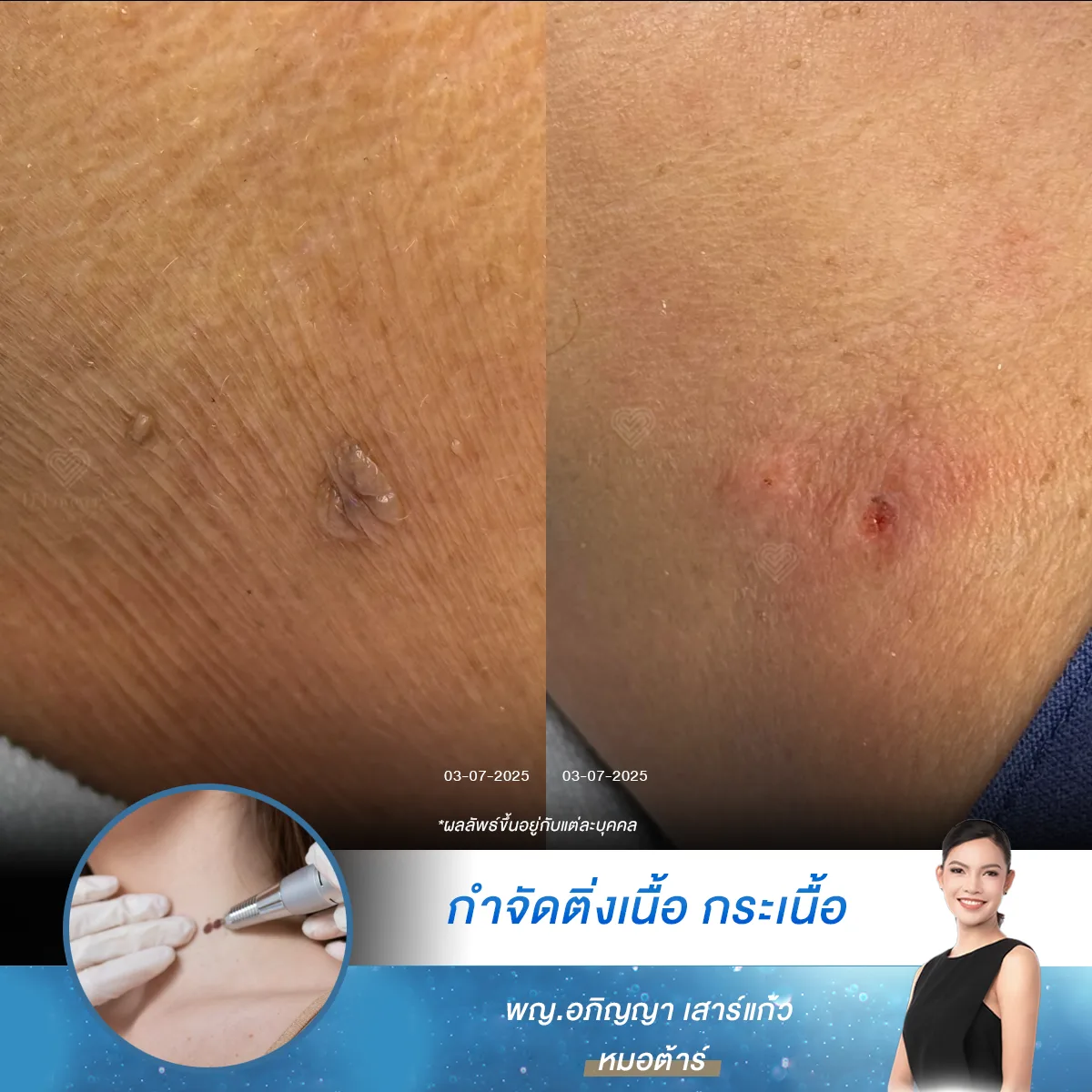 หมดห่วงเรื่องเจ็บและรอยแผลเป็น เมื่อกำจัดไฝกระเนื้อ