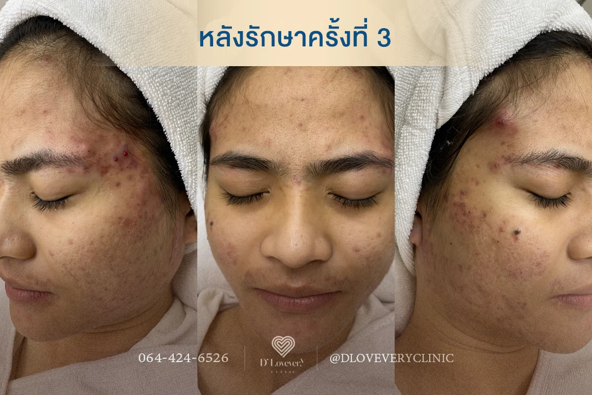 หากหยุดใช้ครีมที่มีสเตียรอยด์เลยทันที ผิวจะยิ่งแย่หรือไม่?