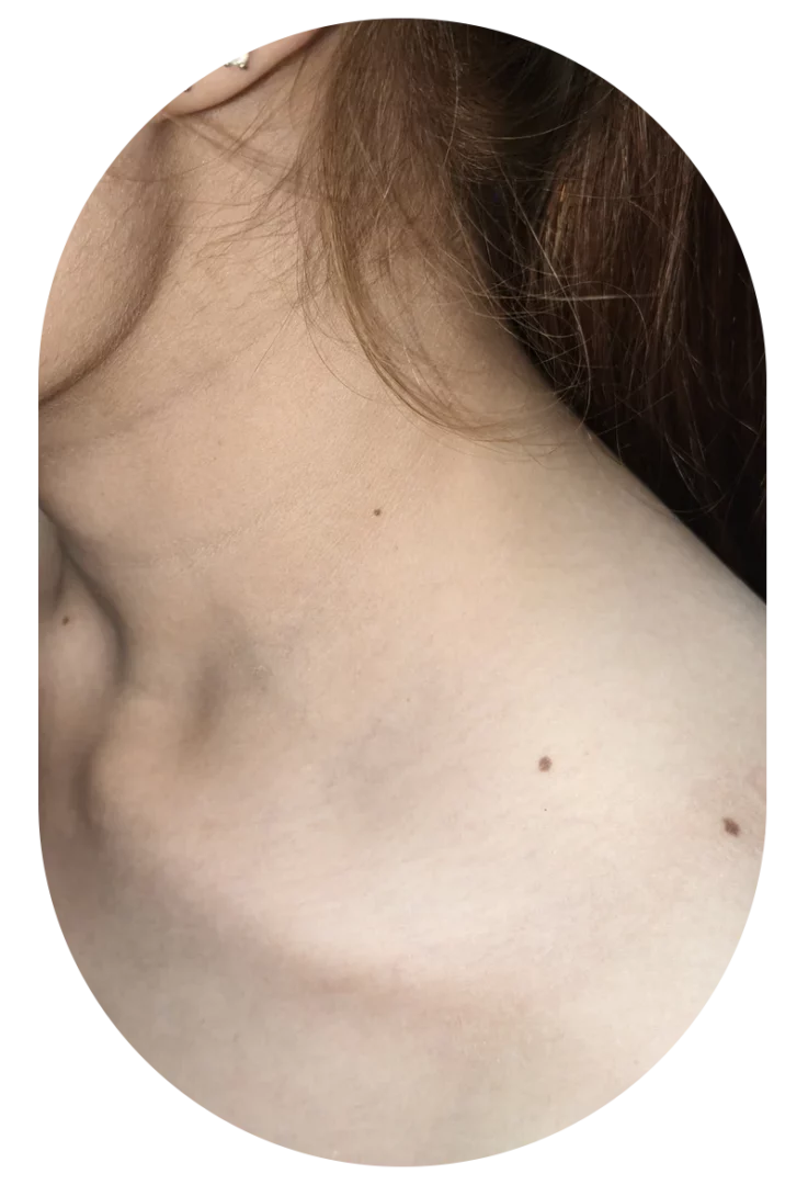 หมดกังวลรอยขี้แมลงวันและกระเนื้อบนใบหน้า ด้วยเทคโนโลยีเลเซอร์ที่ปลอดภัย ผลลัพธ์ถาวร ดูแลโดยหมอต้าร์