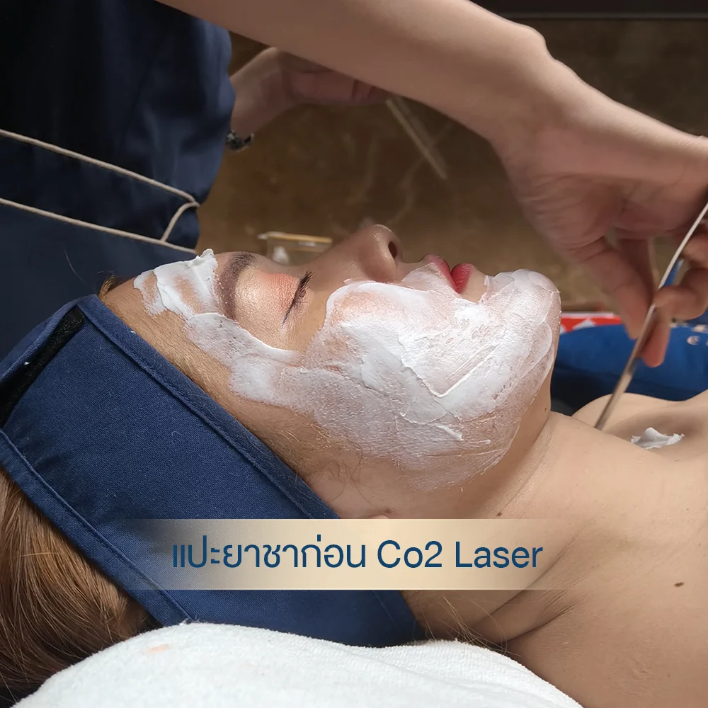 หมดกังวลรอยขี้แมลงวันและกระเนื้อบนใบหน้า ด้วยเทคโนโลยีเลเซอร์ที่ปลอดภัย ผลลัพธ์ถาวร ดูแลโดยหมอต้าร์