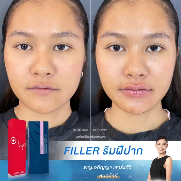 ฉีดฟิลเลอร์ปาก เคส 78 ปากอวบอิ่ม ไม่เป็นร่อง