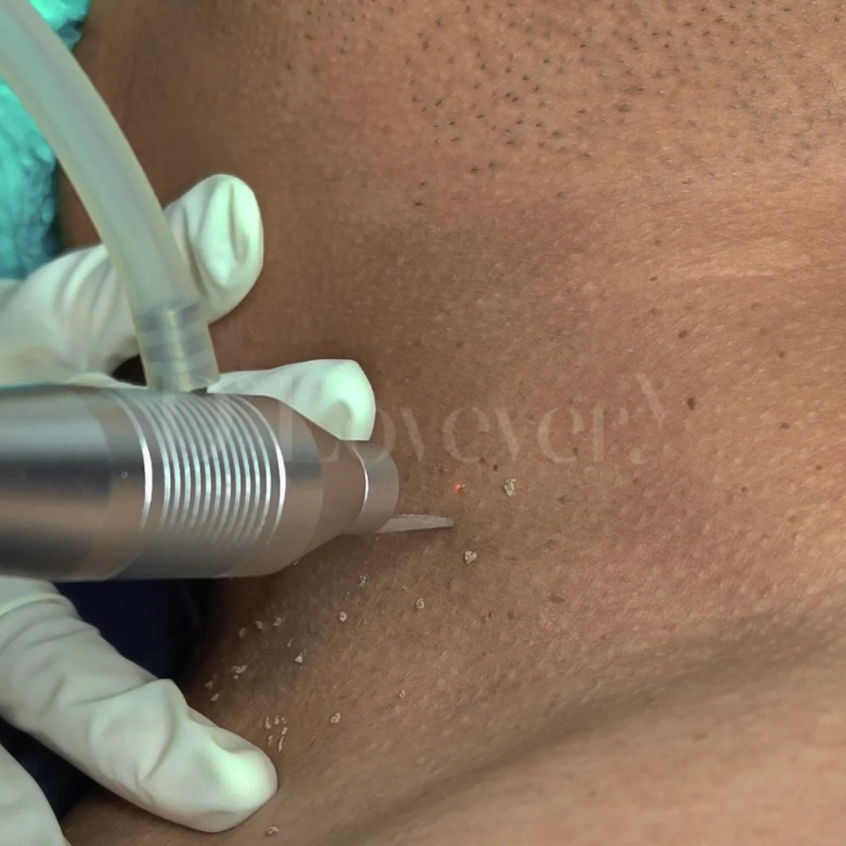 ผลลัพธ์ชัดเจน Co2 Laser กำจัดกระเนื้อรอบคอ ผิวเนียนไม่ทิ้งรอย