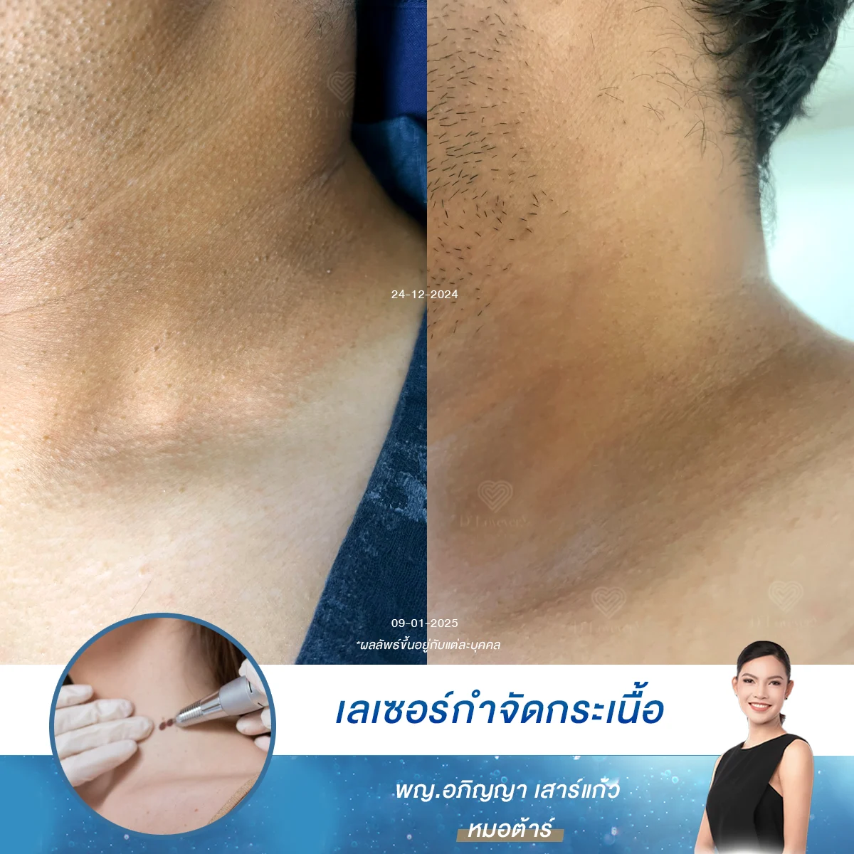 บอกลาคอหมอง! ผู้ชายคนนี้เลือกเลเซอร์ Co2 จัดการกระเนื้อ – ผลลัพธ์เกินคาด