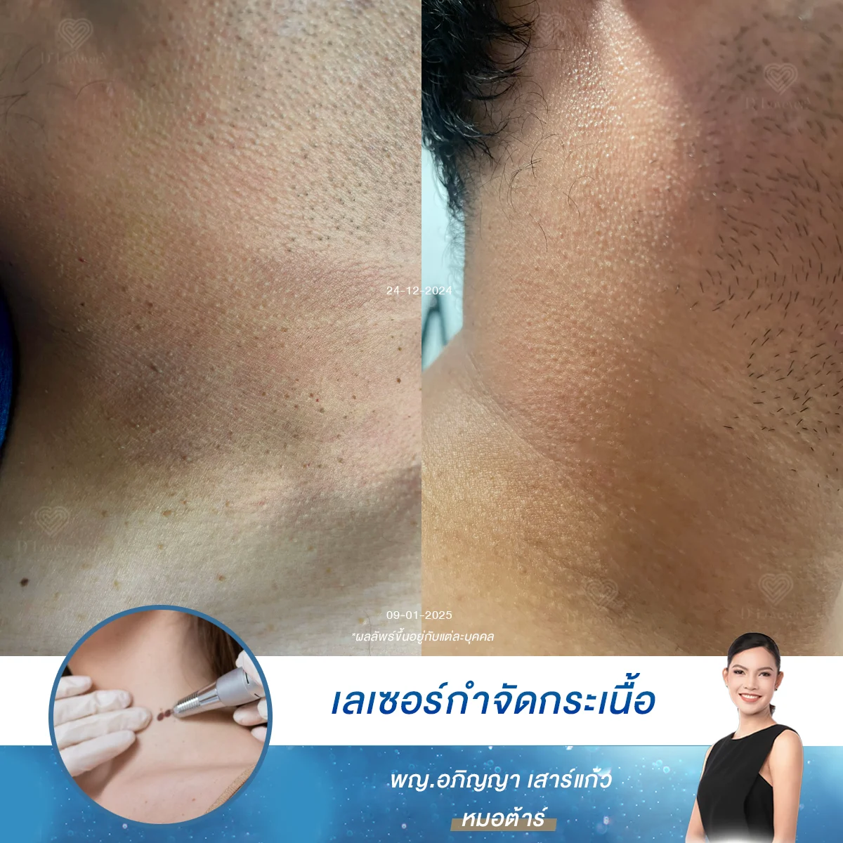รีวิว Co2 Laser เคสจริง รักษากระเนื้อรอบคอ ผิวเนียนขึ้นเห็นชัดใน 2 สัปดาห์