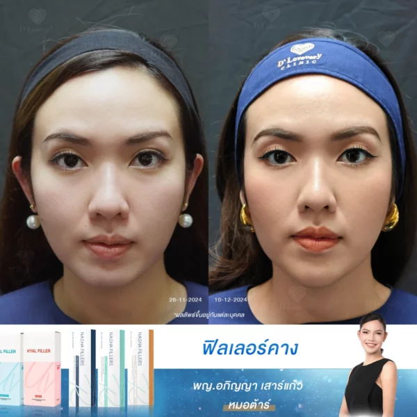 ไม่เชื่อก็ต้องเชื่อ แค่เติมคางก็ช่วยให้หน้าสมส่วนขึ้นได้จริง