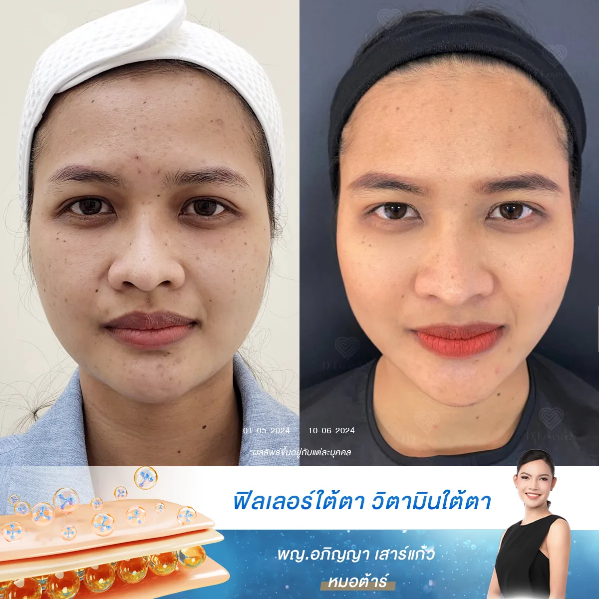 ปัญหาใต้ตาดำเหมือนคนไม่ได้นอน? ถึงเวลาเปลี่ยนตัวเองให้สดใสขึ้นด้วยโปรแกรม D’ Prompt Glow