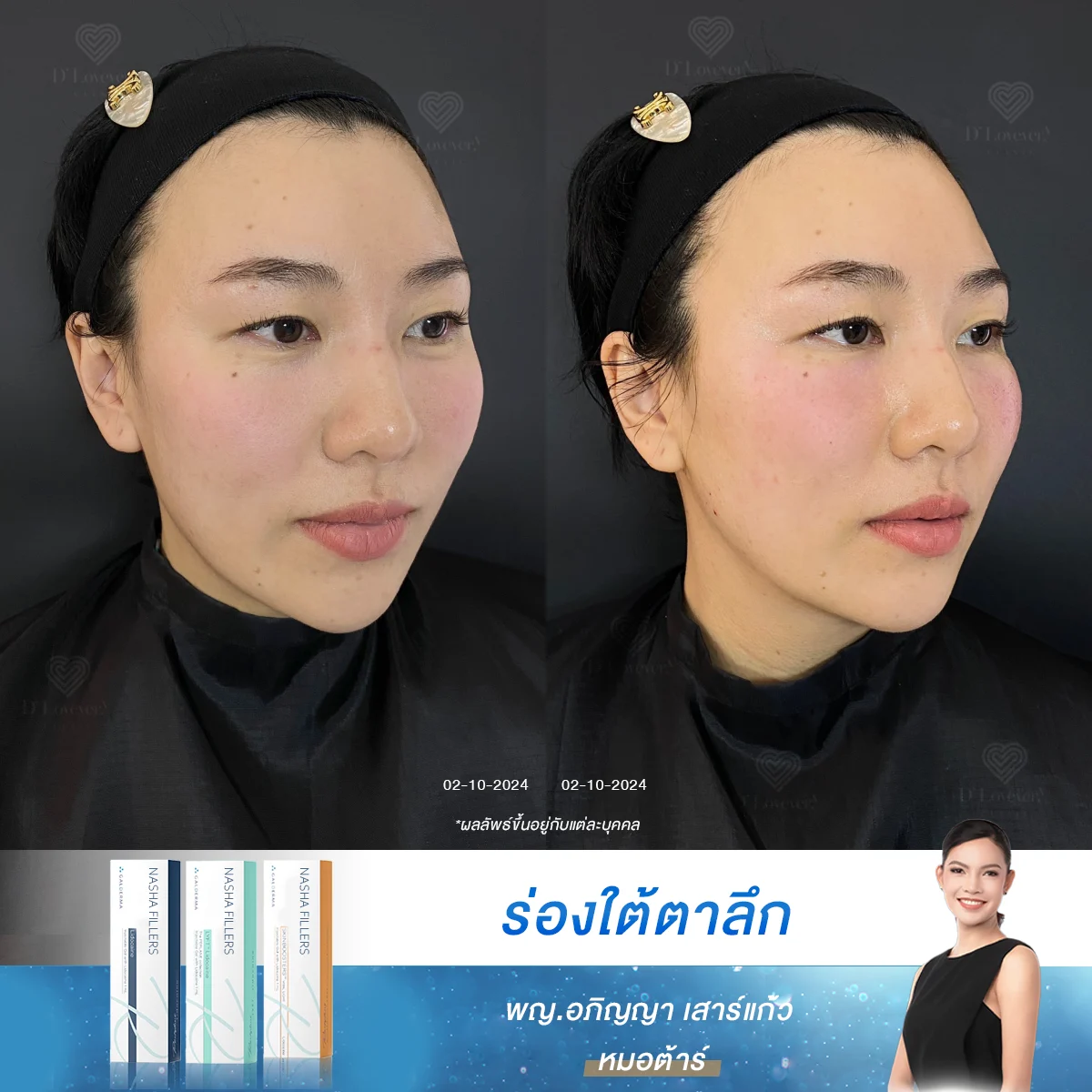 ร่องใต้ตาลึก ทำยังไงได้บ้าง ฉีดฟิลเลอร์จะดีขึ้นแค่ไหน เคส 86