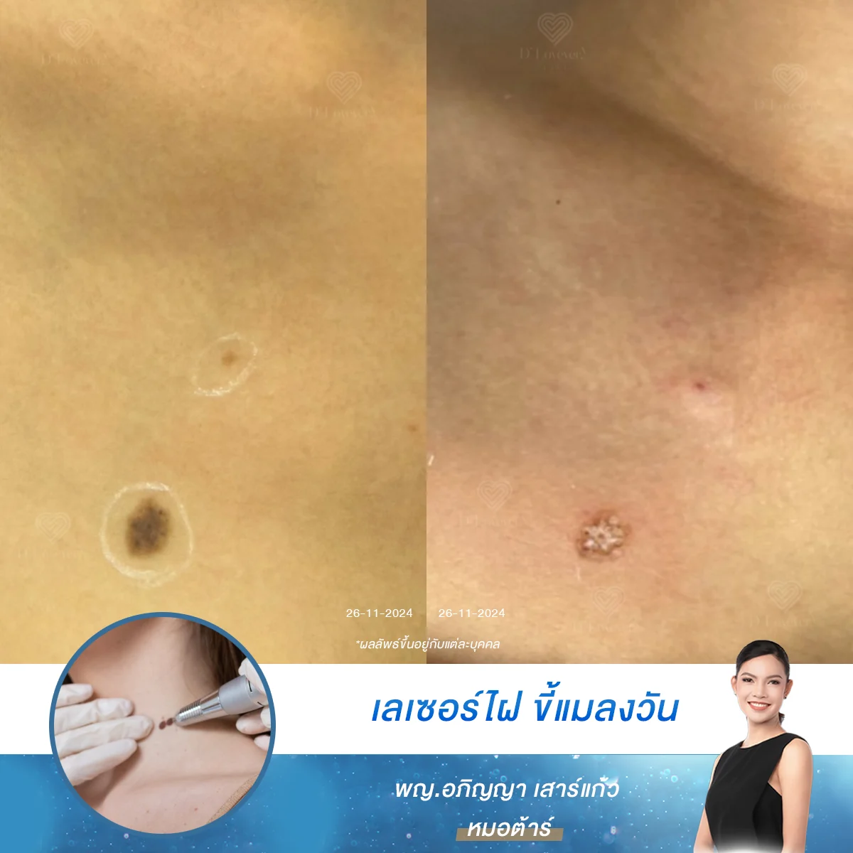หลังทำเลเซอร์จี้ไฝ 1 วัน