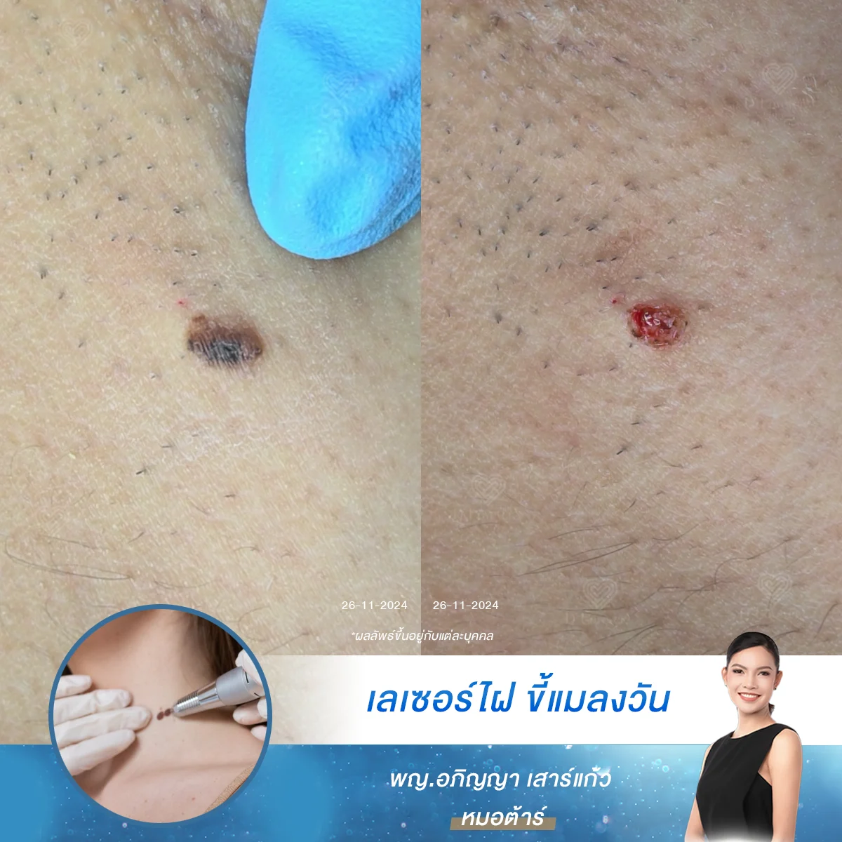 ผลลัพธ์หลังจี้ไฝ